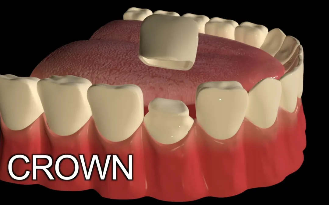 The disadvantages of dental crowns
