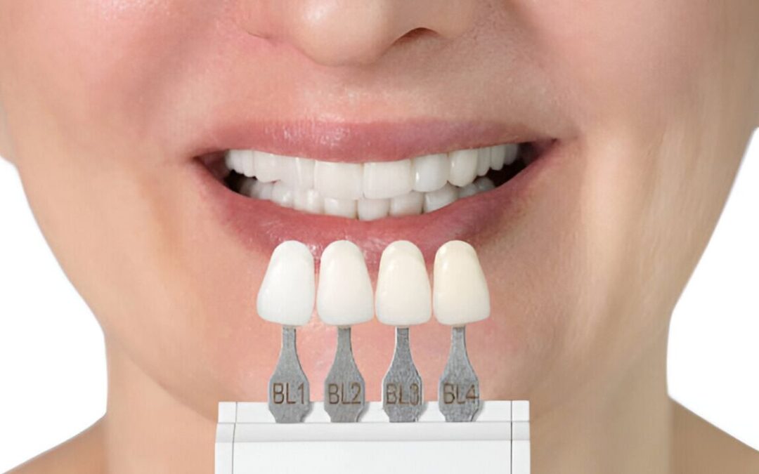 From Application to Admiration: How Long Do Porcelain Veneers Last?