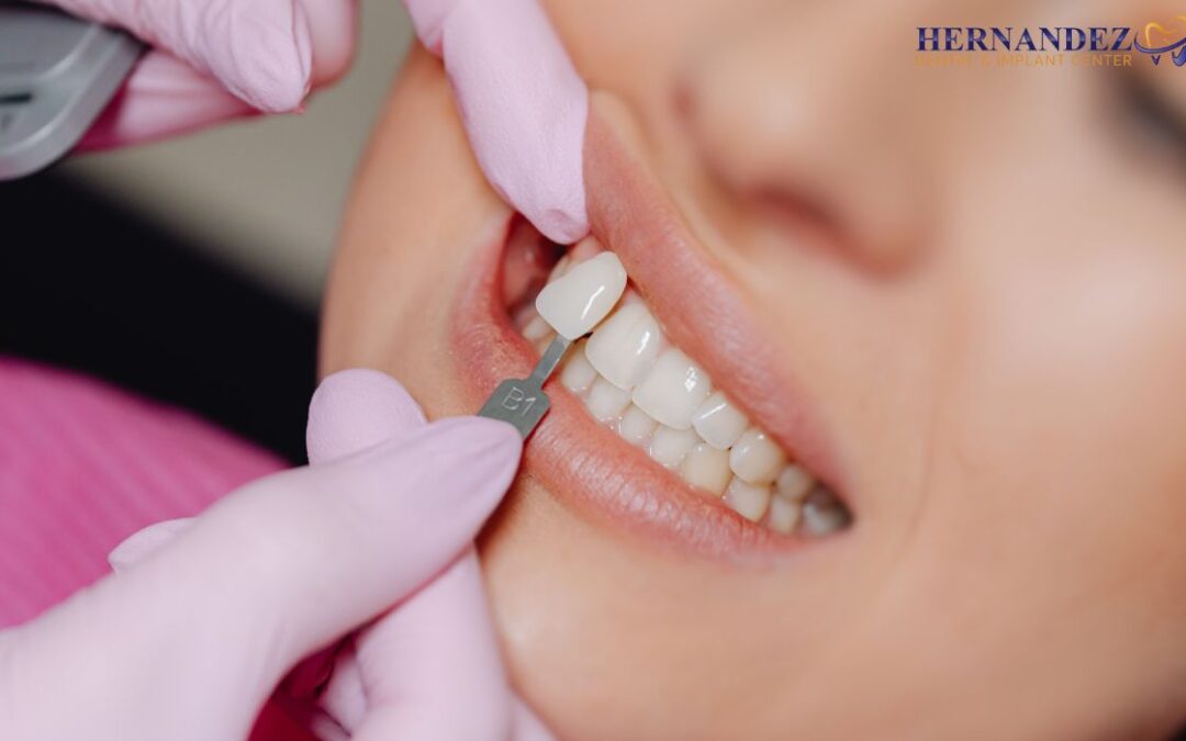 Can Veneers Fix Crooked Teeth in San Antonio, TX?